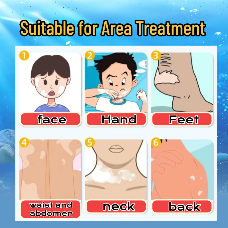 vitiligo treatment options